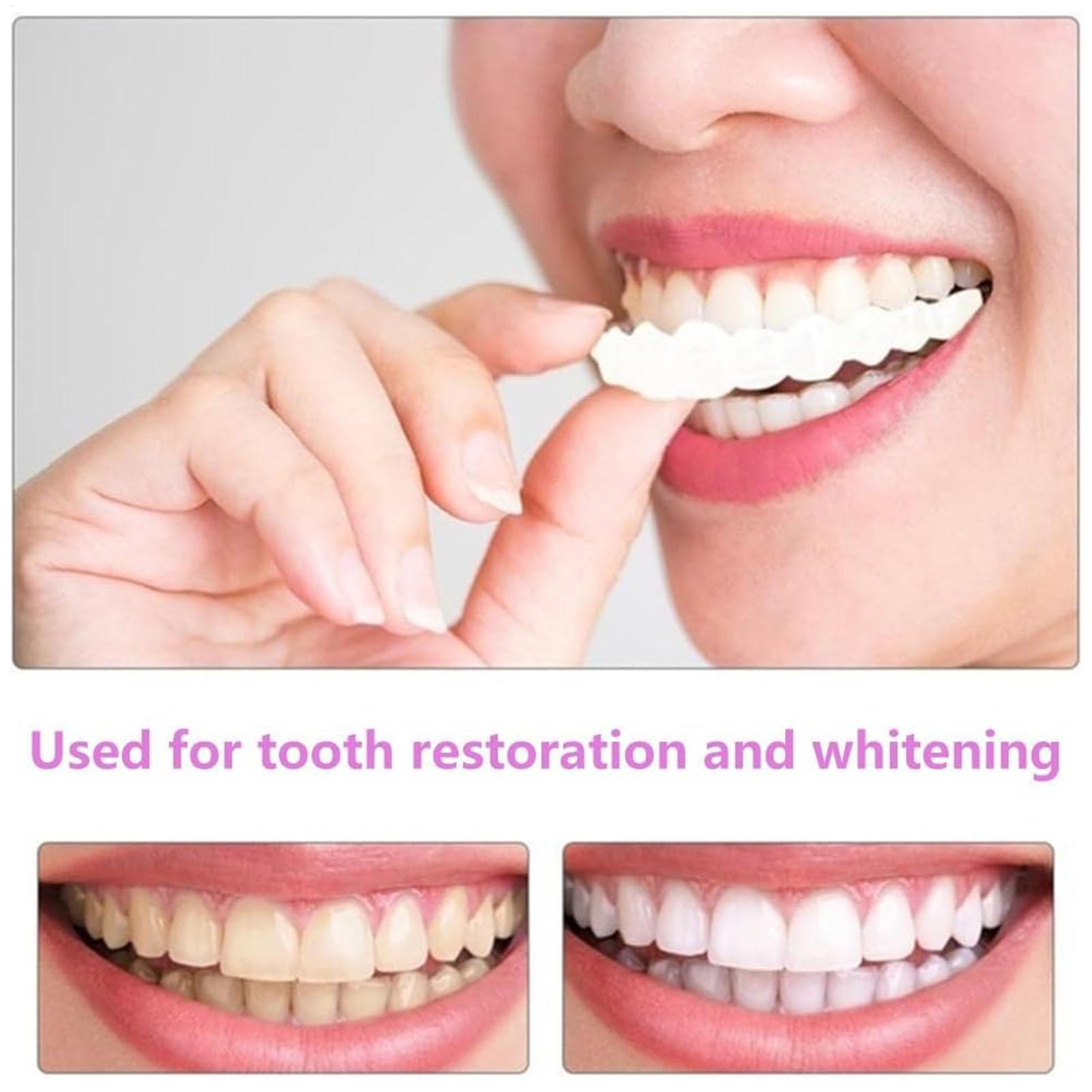Prothèses dentaires supérieure - Teeth Whitening With Braces avis et prix