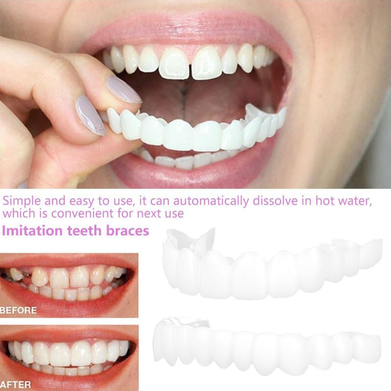 Prothèses dentaires supérieure - Teeth Whitening With Braces avis et prix