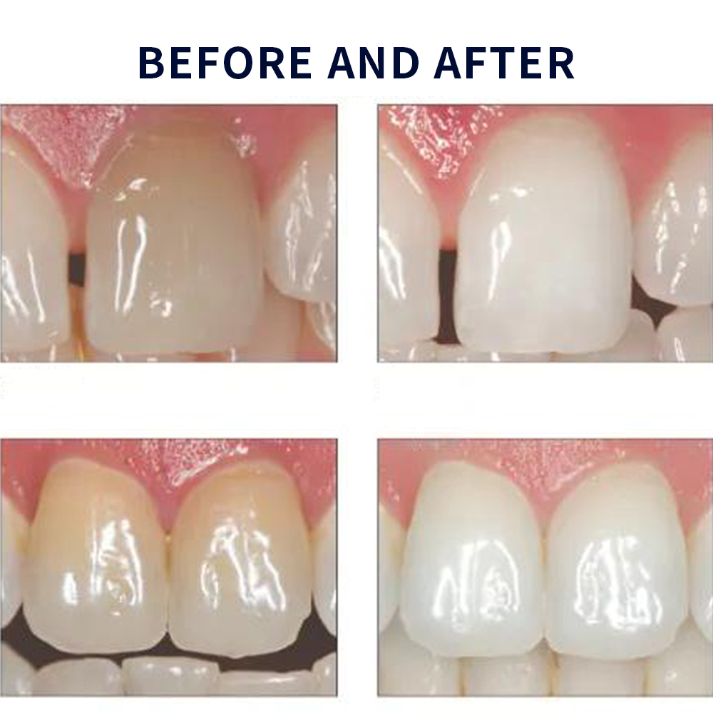 Opalwisdom-Kit de Blanchiment  - Teeth Whitening Gels Used By Dentists avis et prix