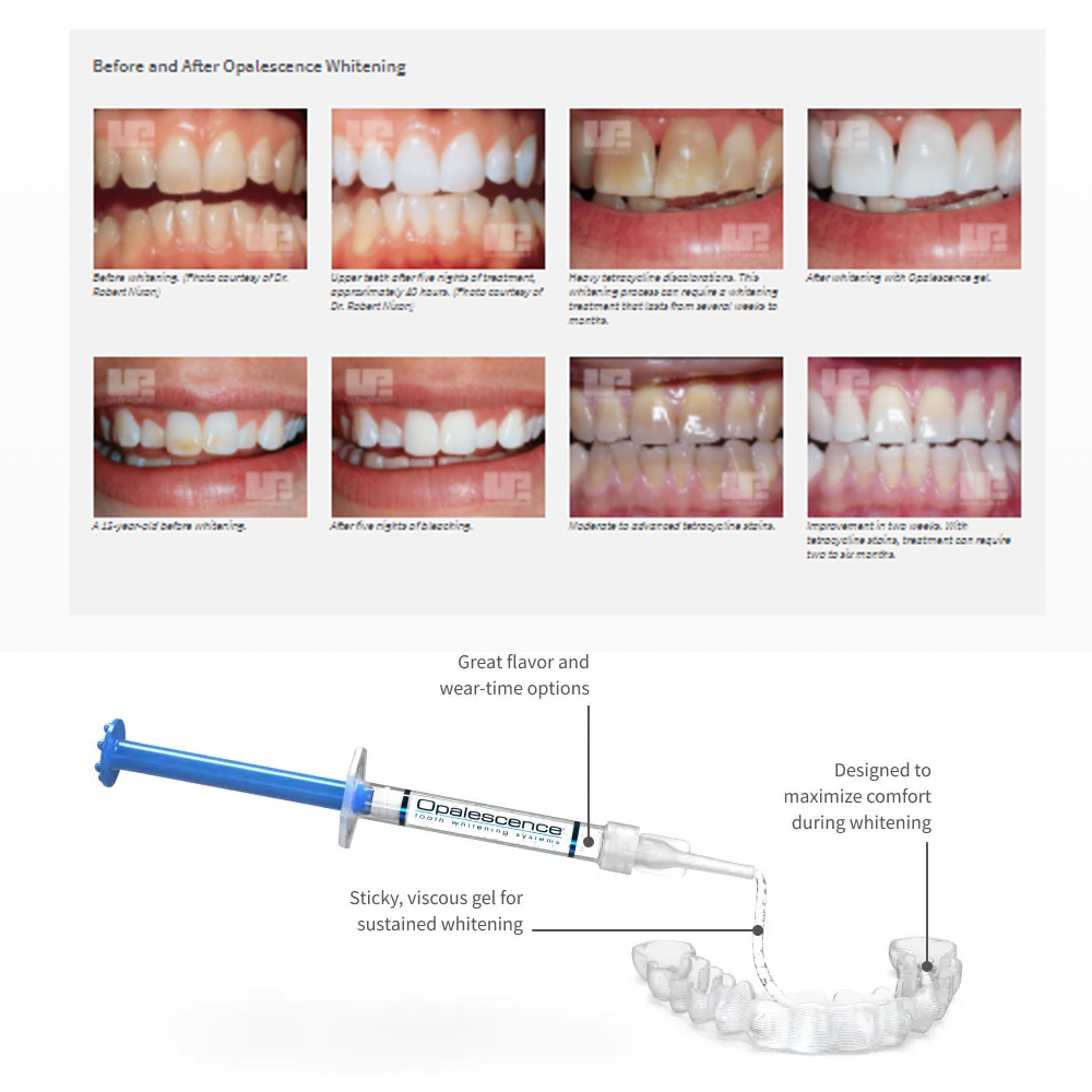 Opalwisdom-Kit de Blanchiment  - Teeth Whitening Gels Used By Dentists avis et prix