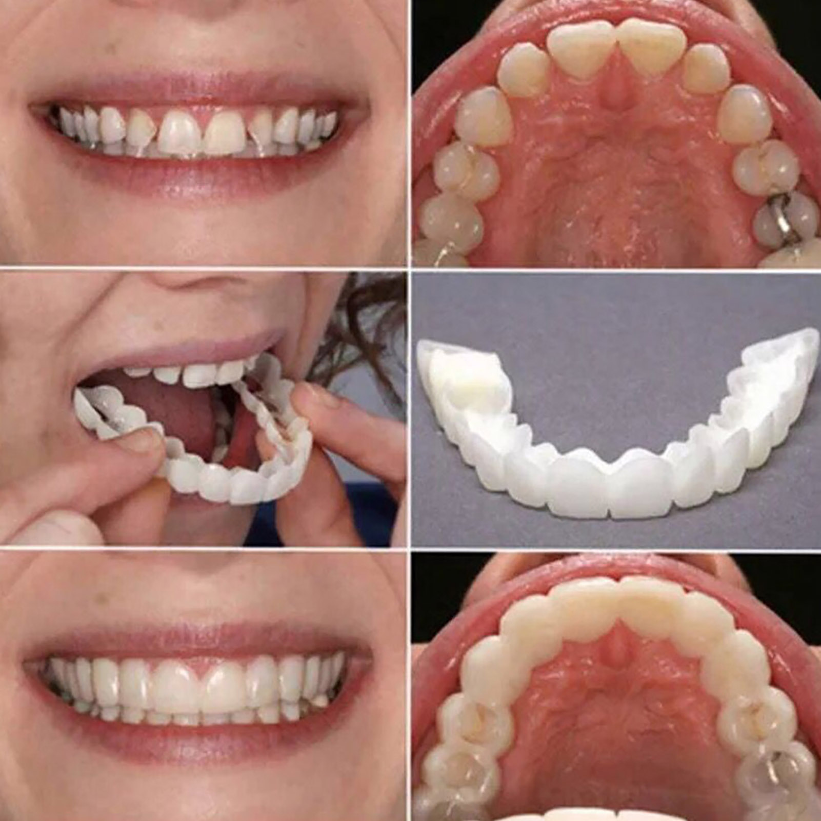 Kit de prothèses dentaires tem - Teeth Whitening With Braces avis et prix
